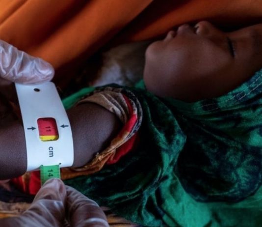 Somalia malnutrición emaciación